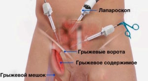 kopiya-laparoscopic-femoral-hernia-repair-1