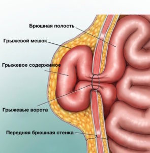 kopiya-ventral-hernia